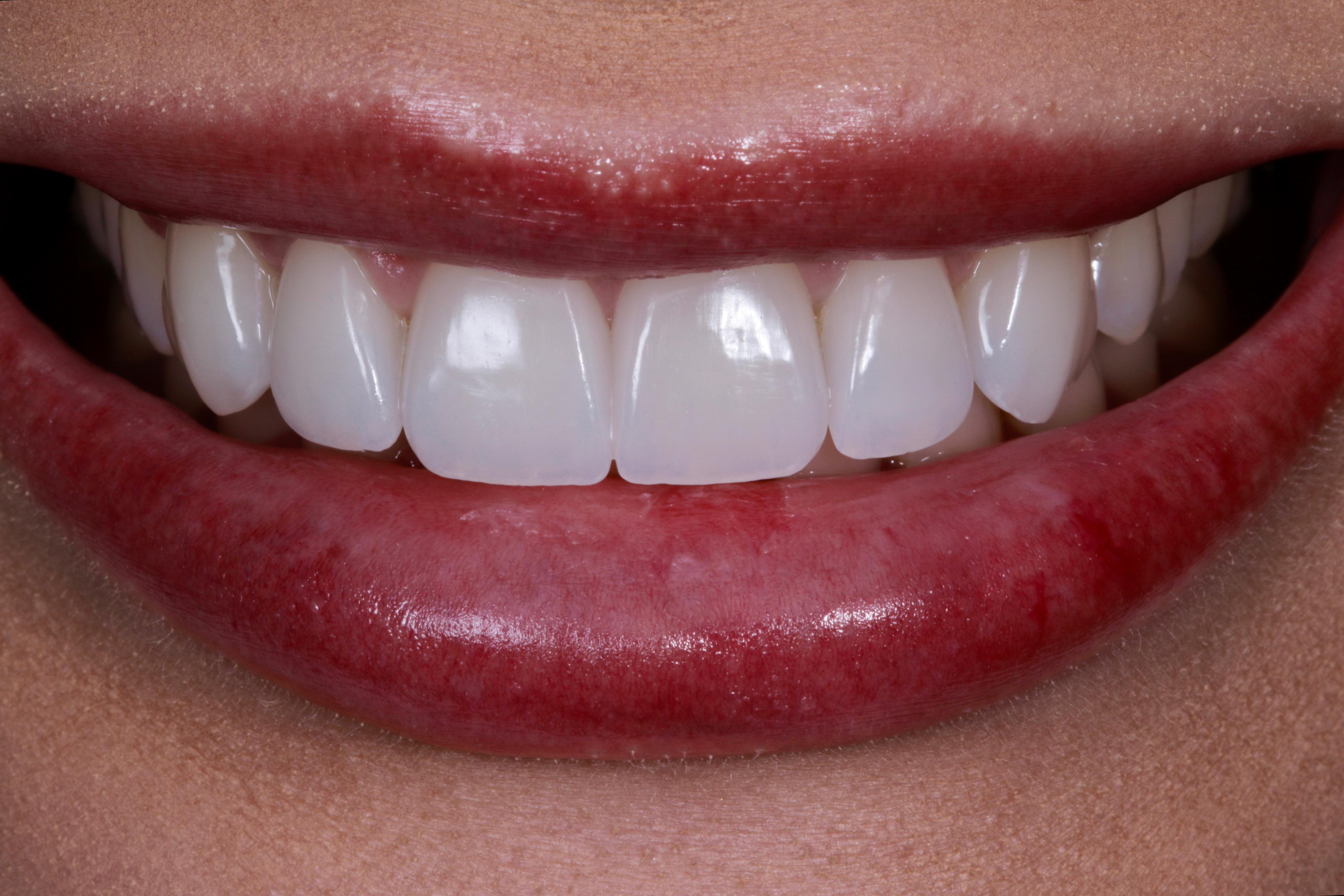 Sorriso com lentes de contato dentais