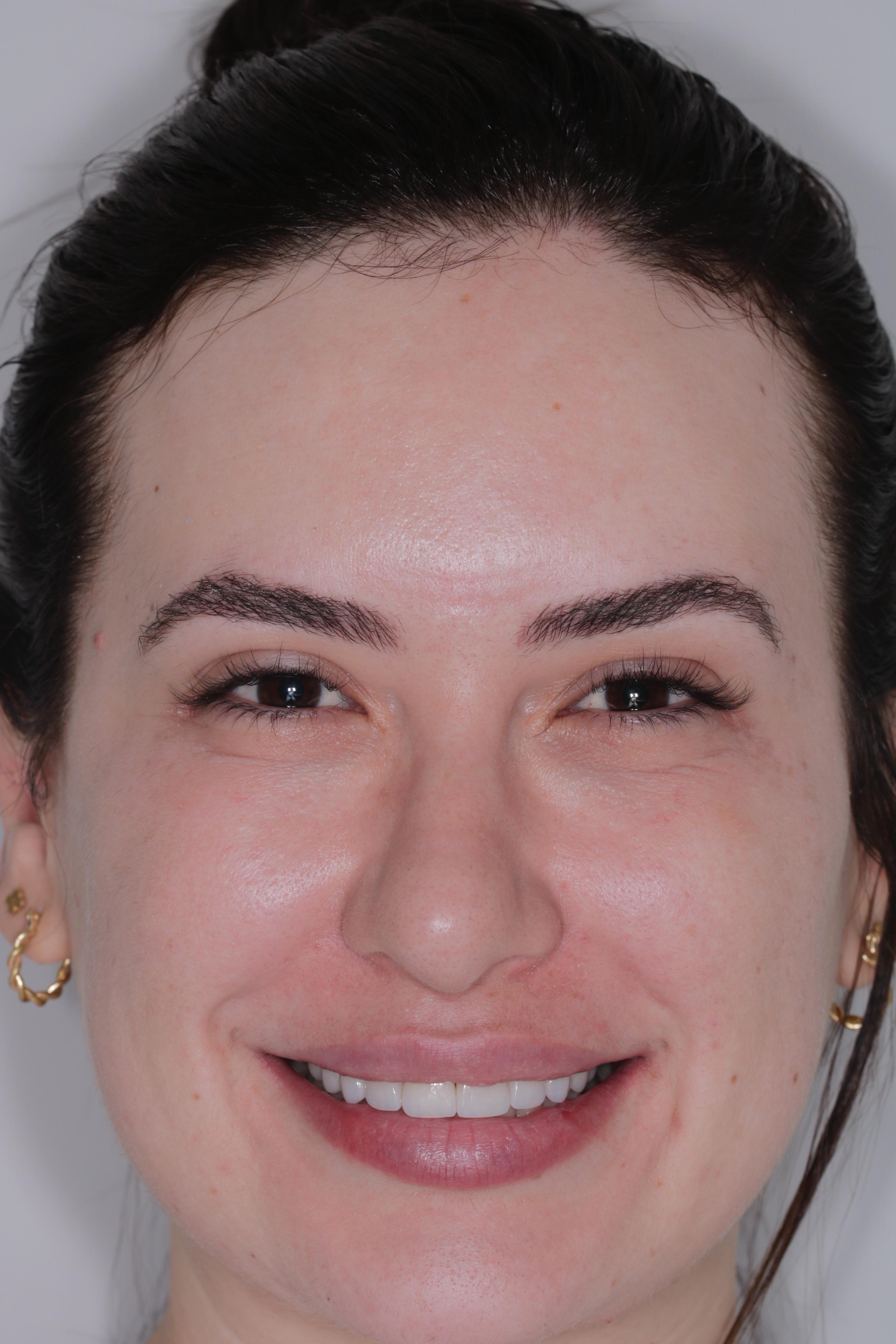 Depois do tratamento com lentes de porcelana - Paciente 1