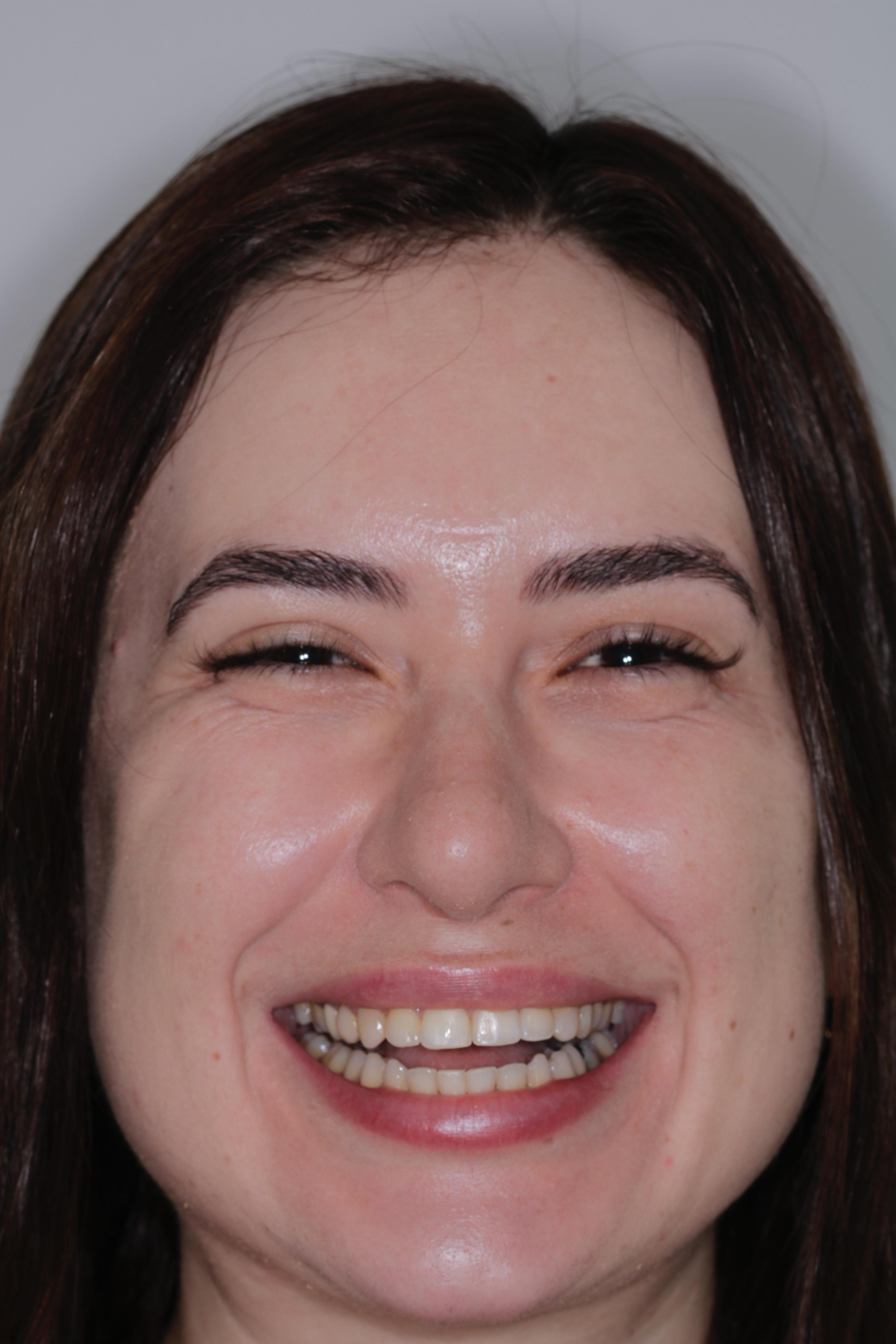 Antes do tratamento com lentes de porcelana - Paciente 1