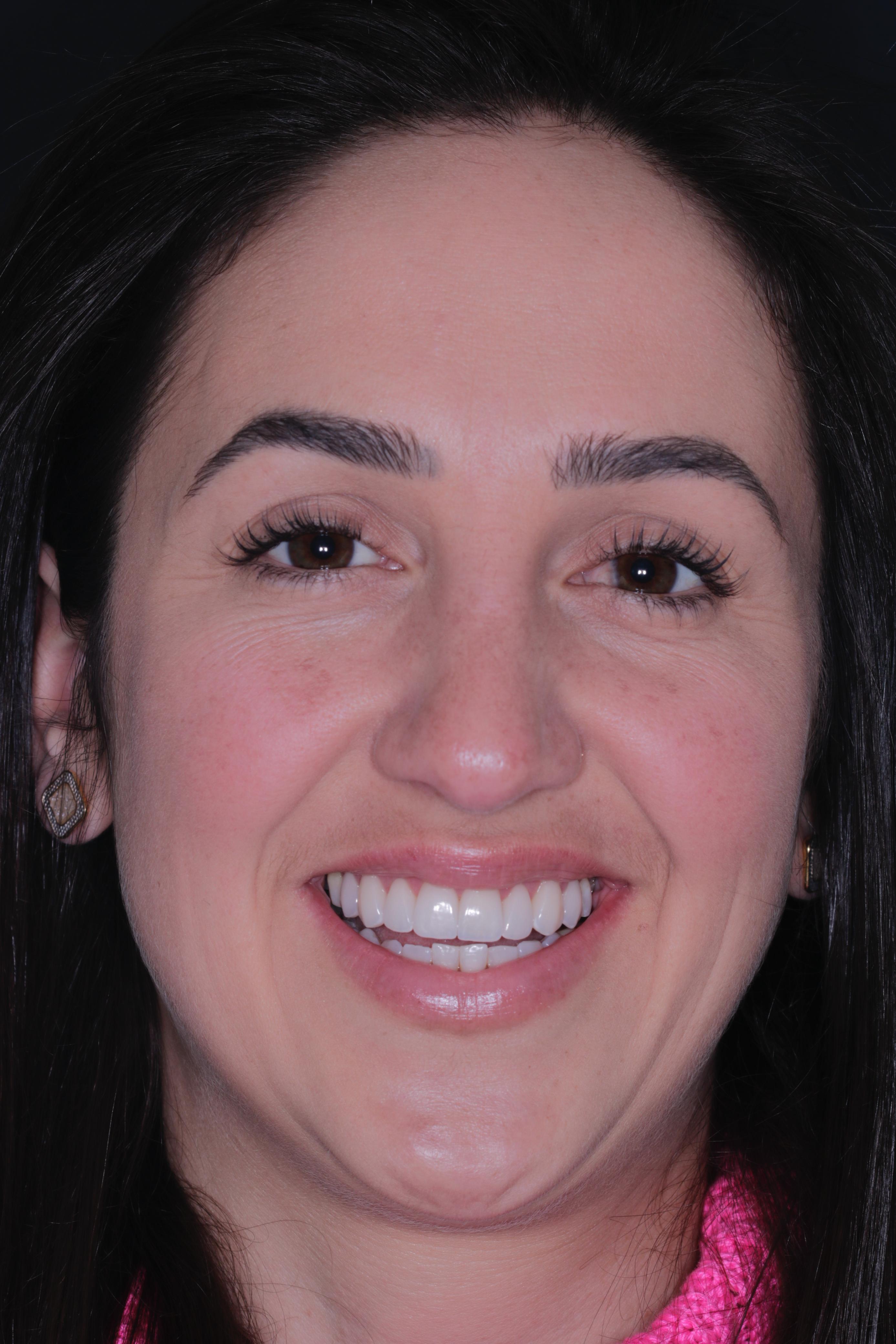 Depois do tratamento com lentes de porcelana - Paciente 2