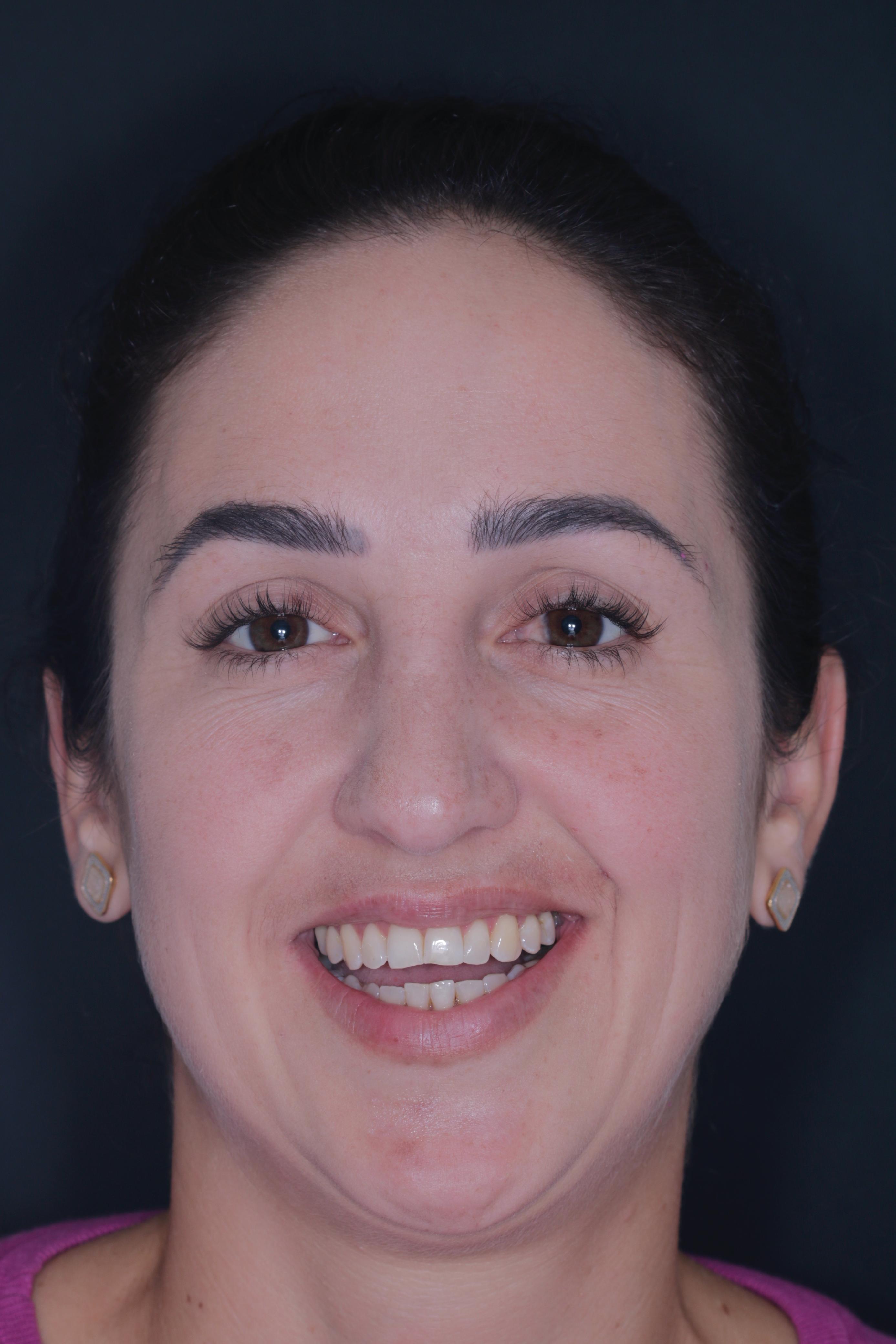 Antes do tratamento com lentes de porcelana - Paciente 2